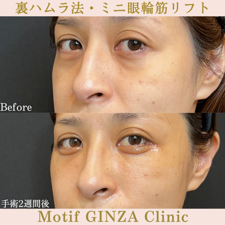 裏ハムラ法・ミニ眼輪筋リフト（手術１か月）の写真4