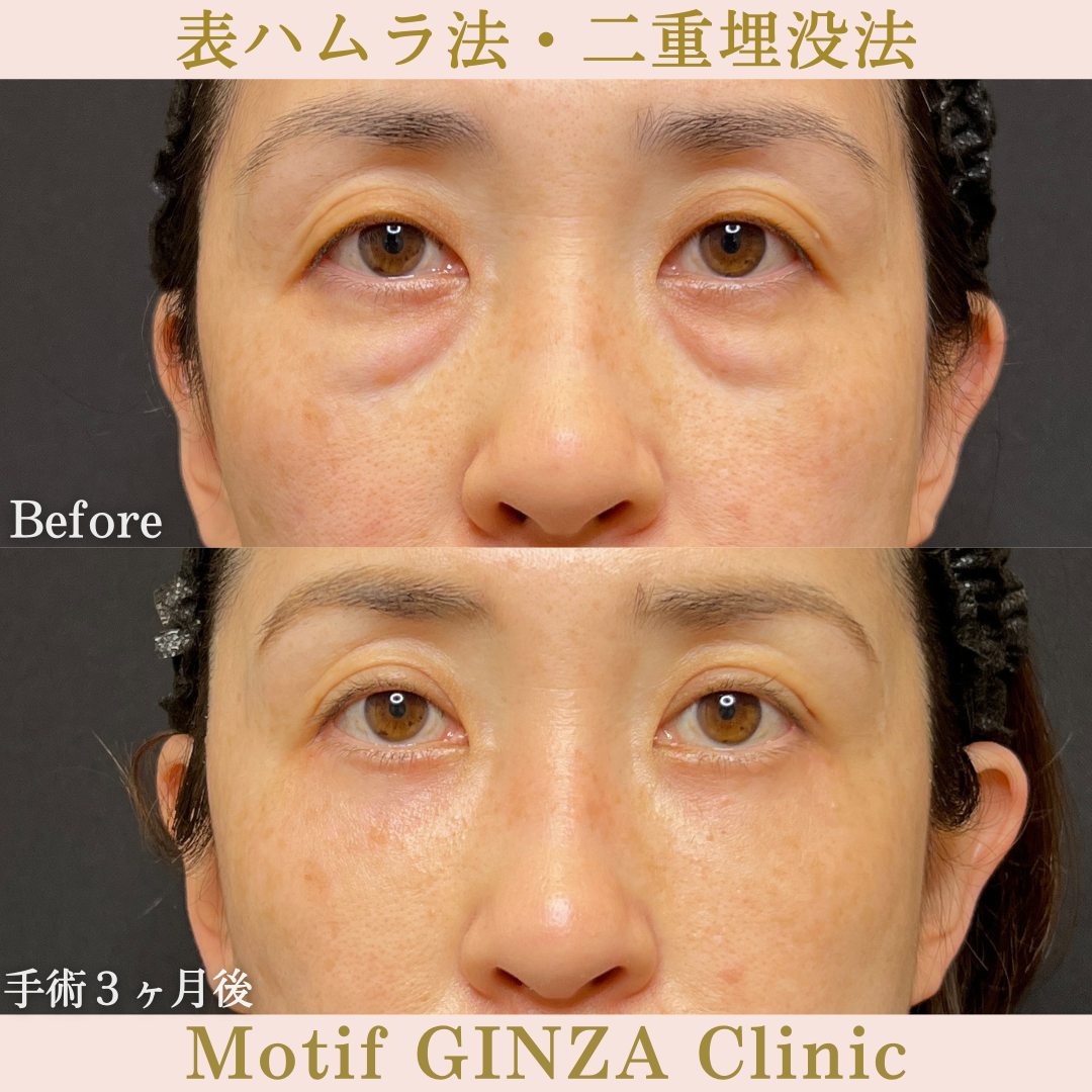切開式下眼瞼たるみ取り・二重埋没法（手術６ヶ月）の写真2