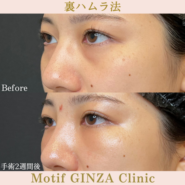 裏ハムラ法（手術３か月）の写真6