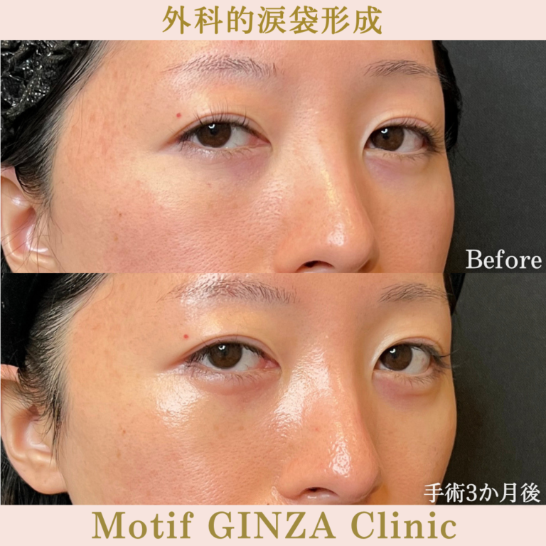 外科的涙袋形成術（手術3か月）の写真2