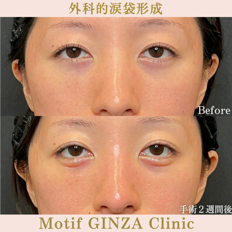 外科的涙袋形成術（手術１か月）の写真3