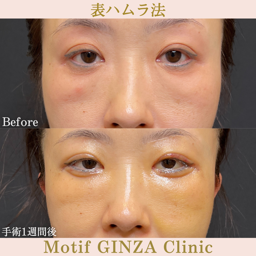 切開式下眼瞼たるみ取り(手術6ヶ月)の写真6