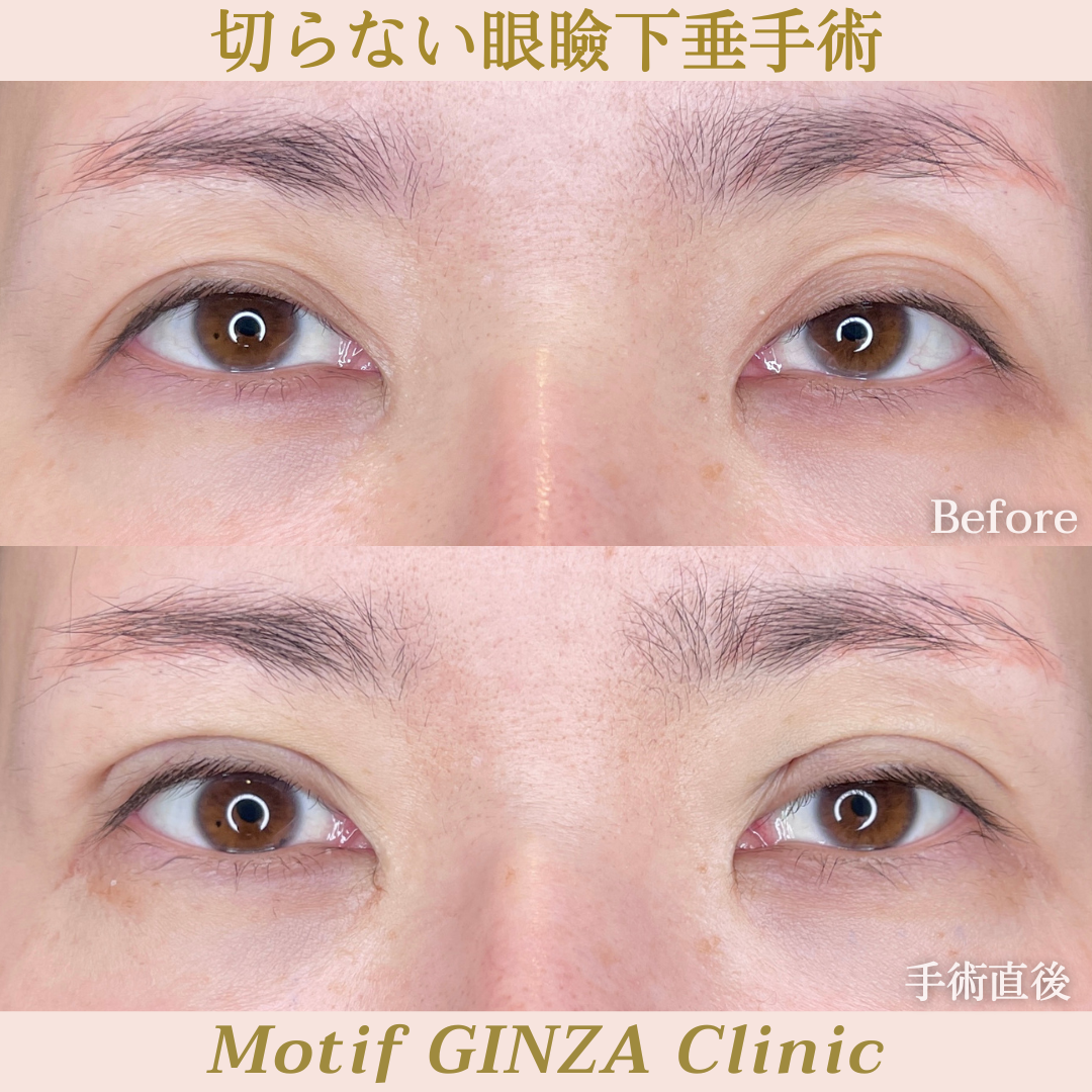 切らない眼瞼下垂手術（手術３ヶ月）の写真3