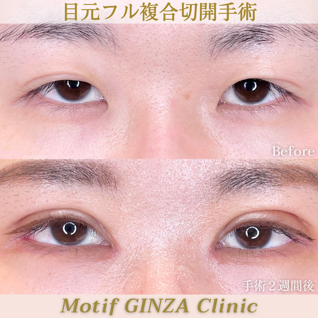 目元複合切開(手術3ヶ月)の写真4