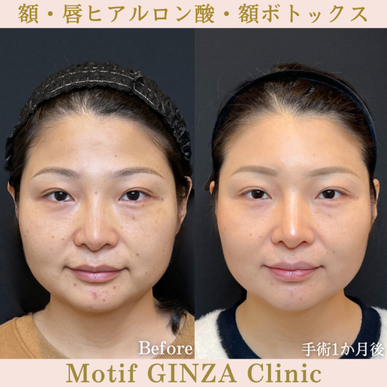 額・唇ヒアルロン酸・額ボトックス（手術１か月）の写真2