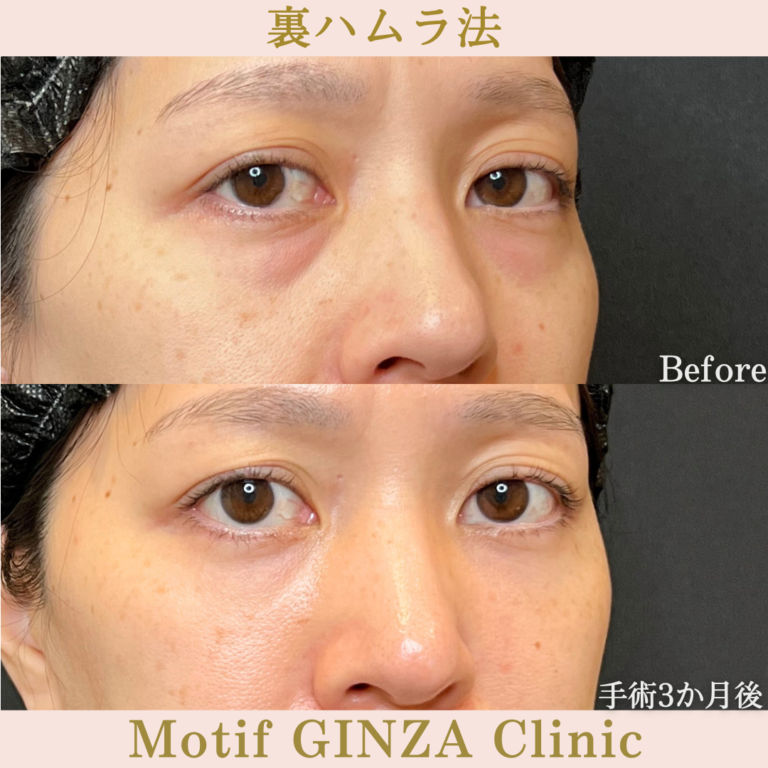 裏ハムラ法（手術3か月）の写真2
