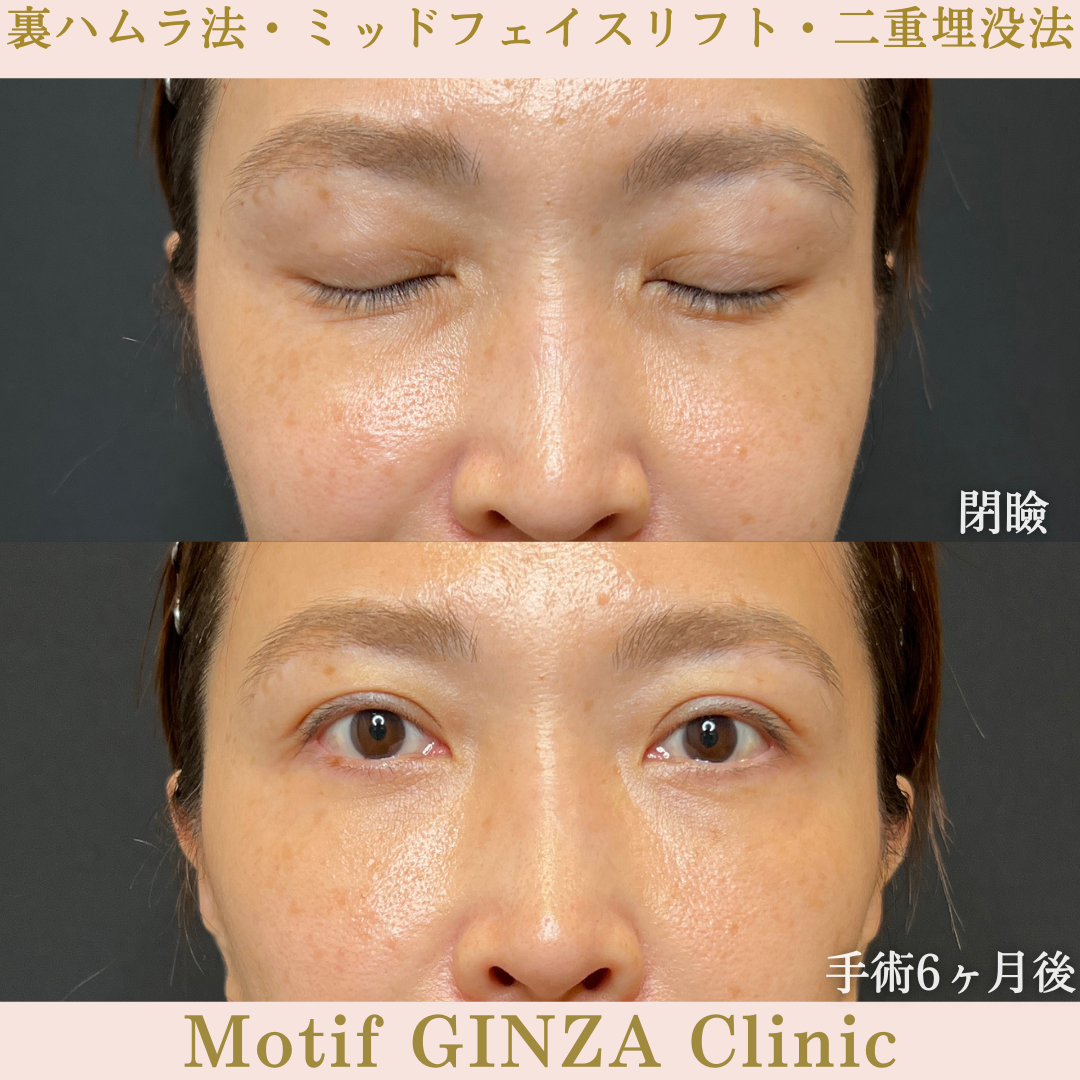 裏ハムラ法・ミッドフェイスリフト・二重埋没法（手術６ヶ月）の写真2