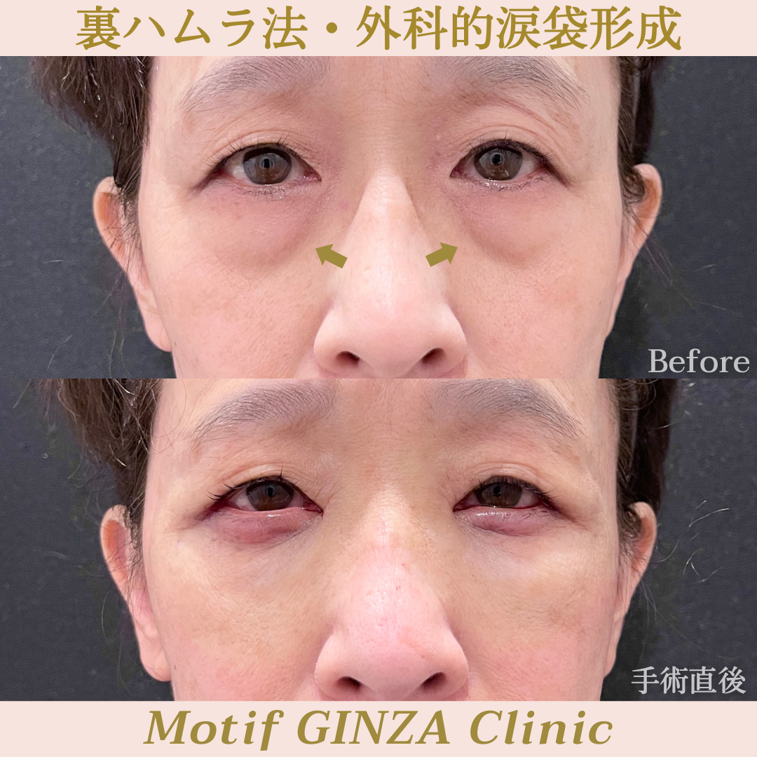 裏ハムラ法・外科的涙袋形成(手術1ヶ月)の写真5