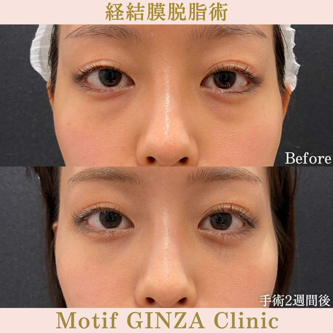 経結膜脱脂術（手術2週間）の写真