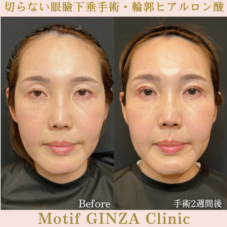切らない眼瞼下垂手術・輪郭ヒアルロン酸（手術１か月）の写真3