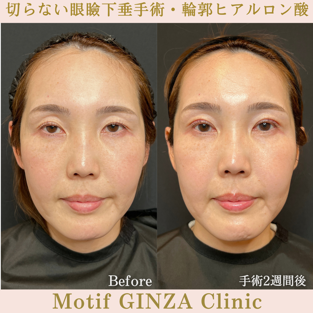 切らない眼瞼下垂手術・輪郭ヒアルロン酸(手術1か月)の写真3