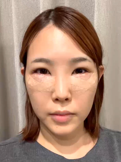 裏ハムラ法 術後4時間