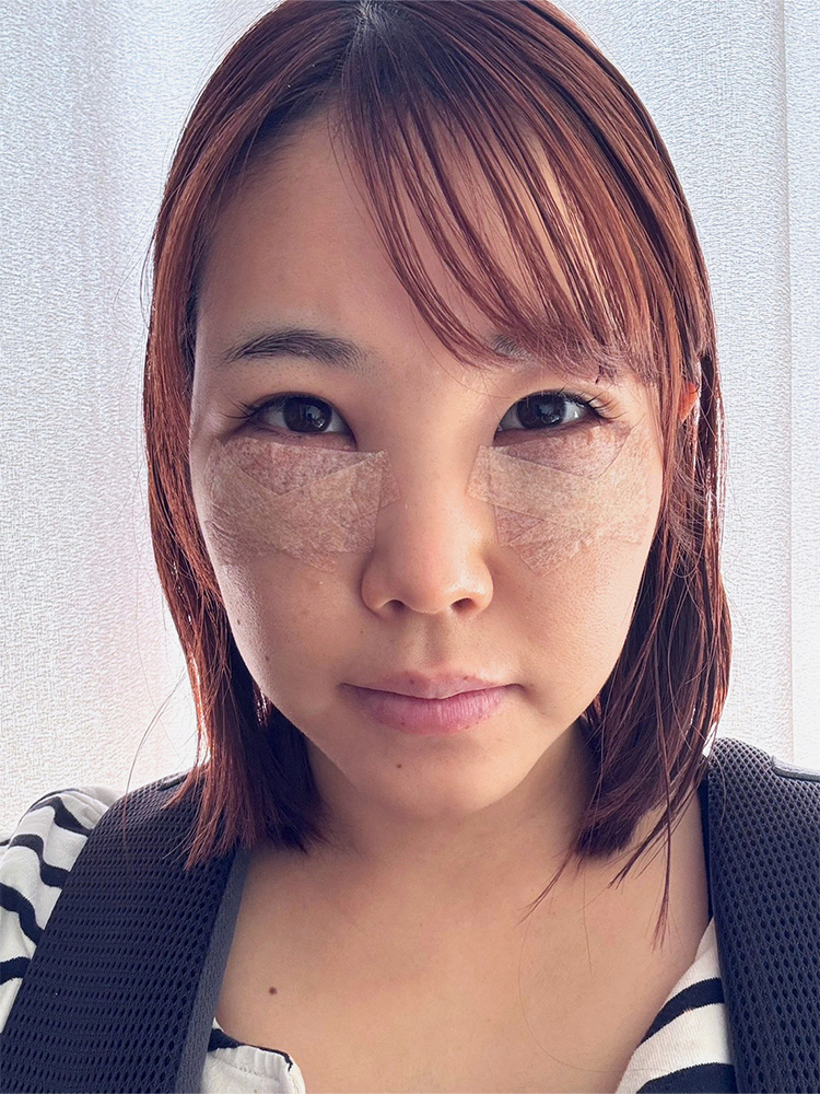 裏ハムラ法 術後1日目