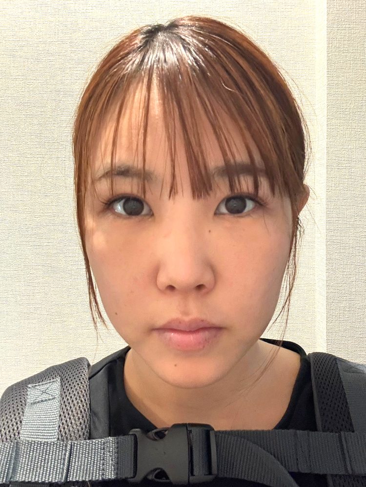 裏ハムラ法 術後10日目