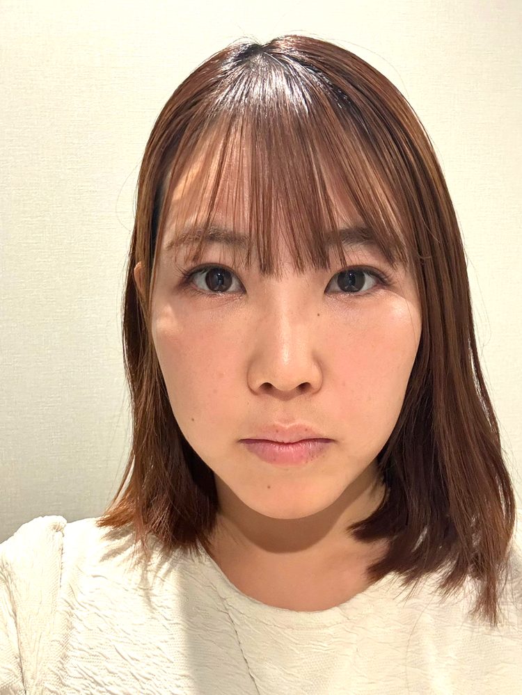 裏ハムラ法 術後12日目