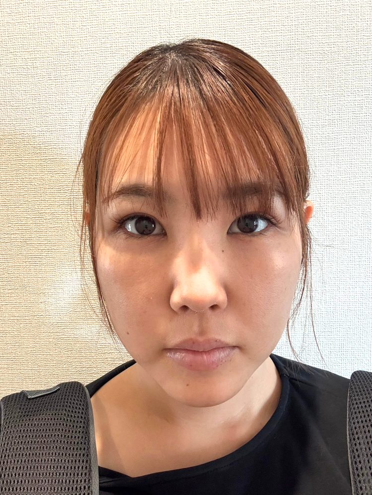 裏ハムラ法 術後14日目