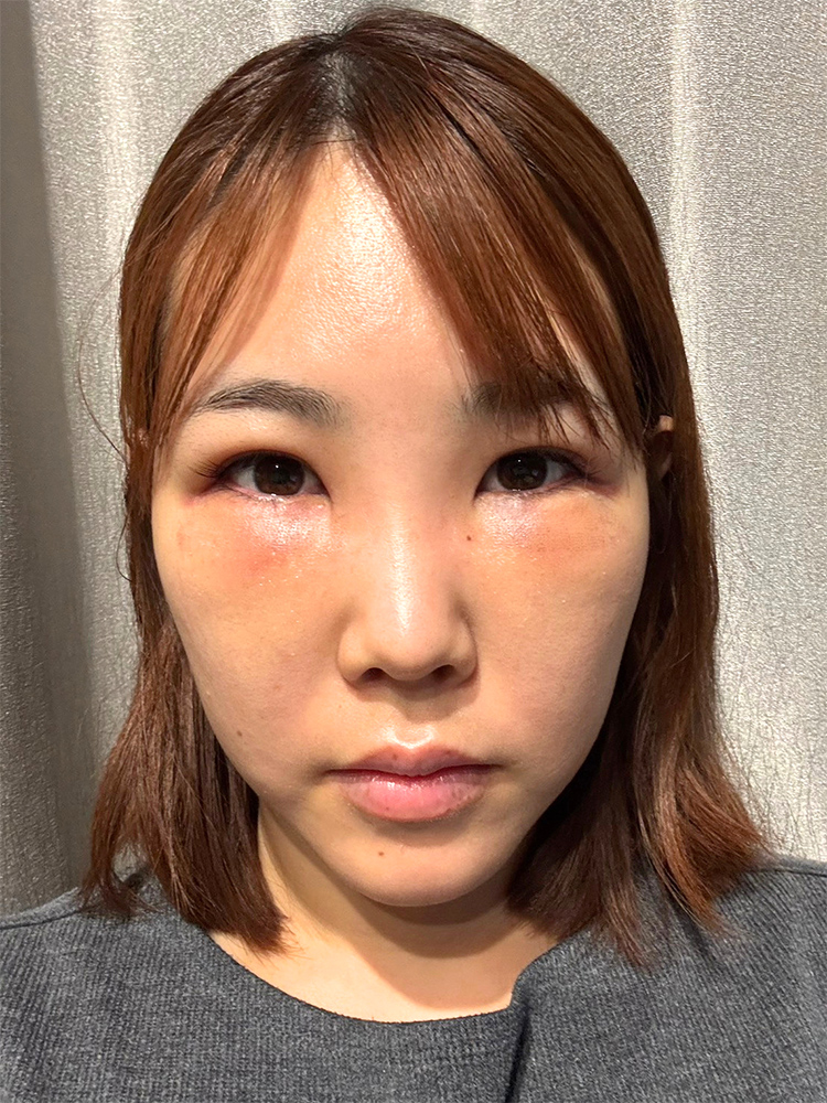 裏ハムラ法 術後2日目