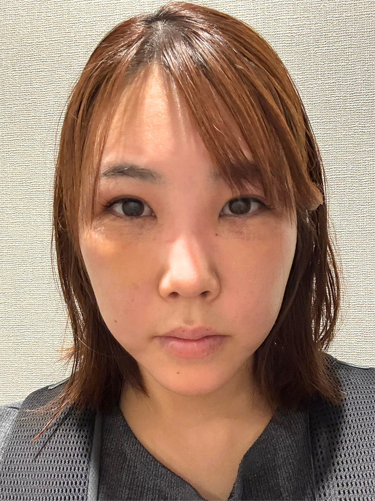 裏ハムラ法 術後3日目