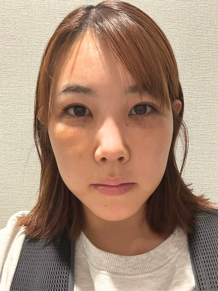 裏ハムラ法 術後4日目