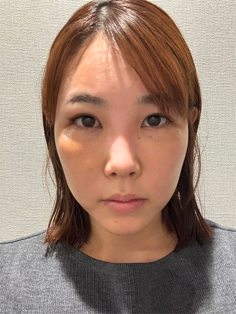 裏ハムラ法 術後5日目