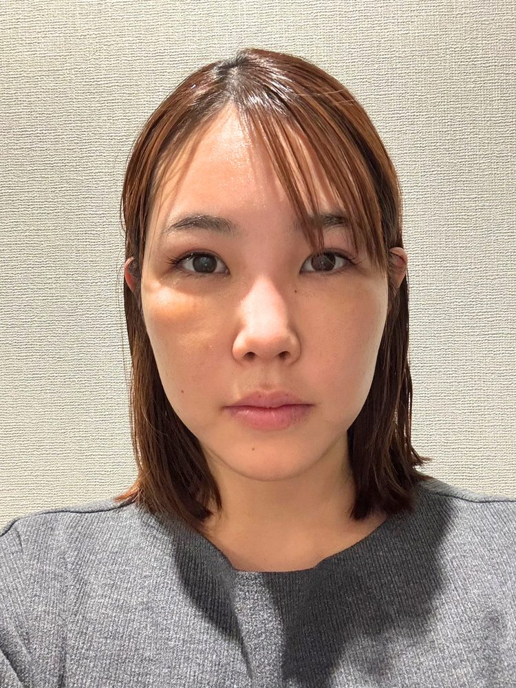 裏ハムラ法 術後6日目の経過写真（腫れがかなり軽減した状態）