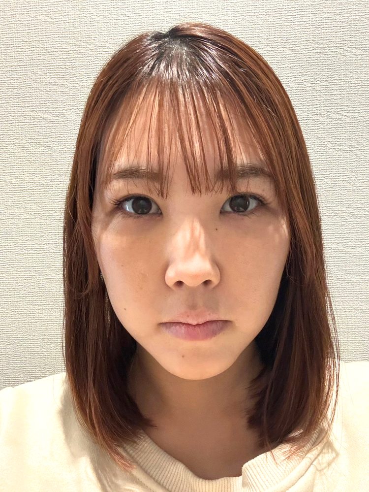 裏ハムラ法 術後7日目の経過写真