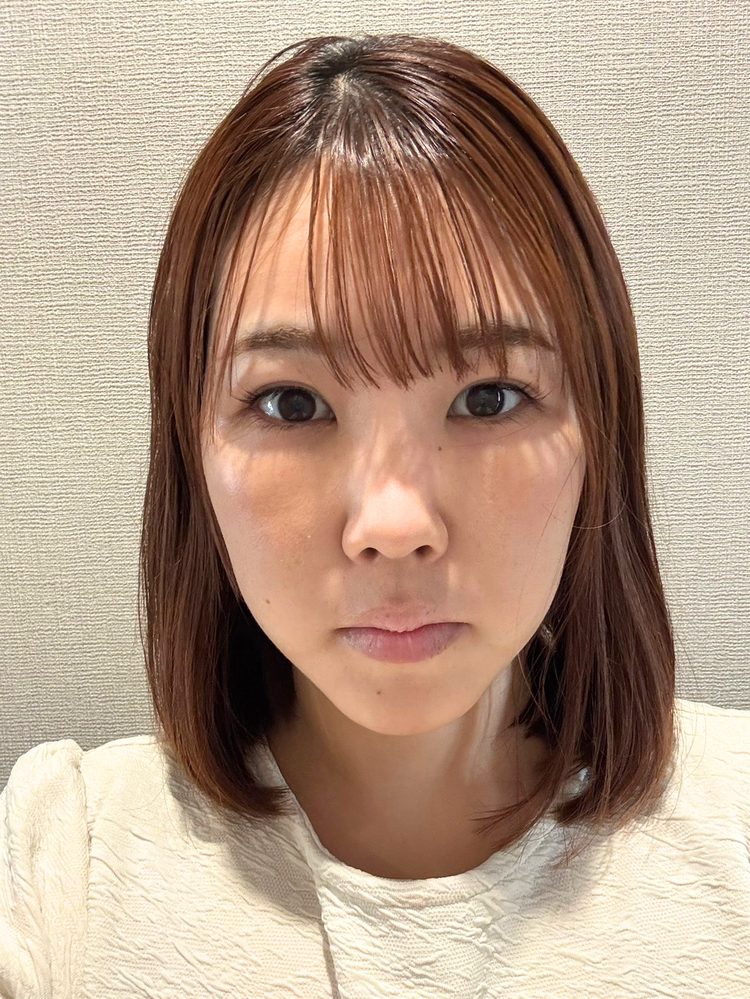 裏ハムラ法 術後8日目