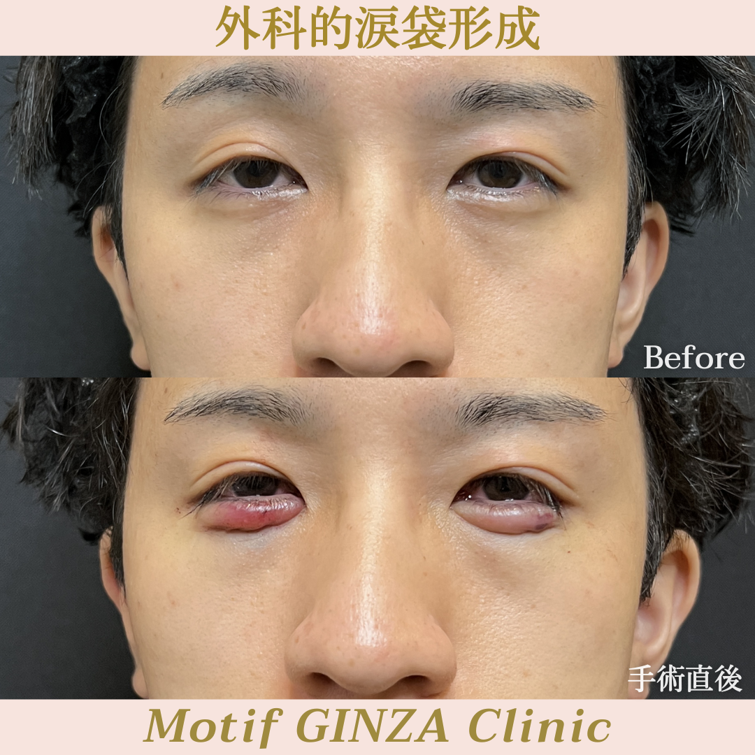 外科的涙袋形成(手術1ヶ月)の写真3