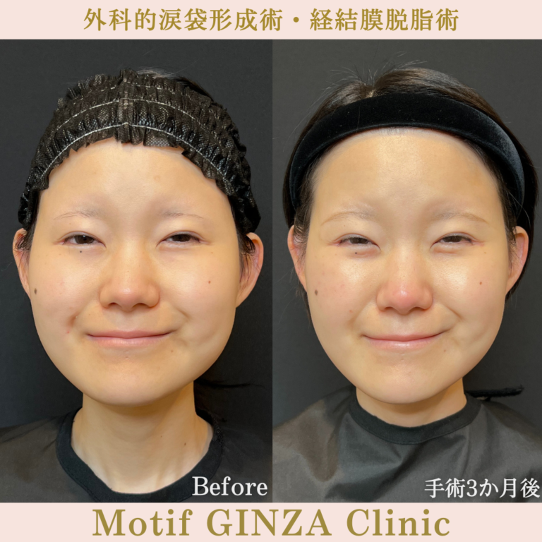 外科的涙袋形成術・経結膜脱脂術（手術３か月）の写真2