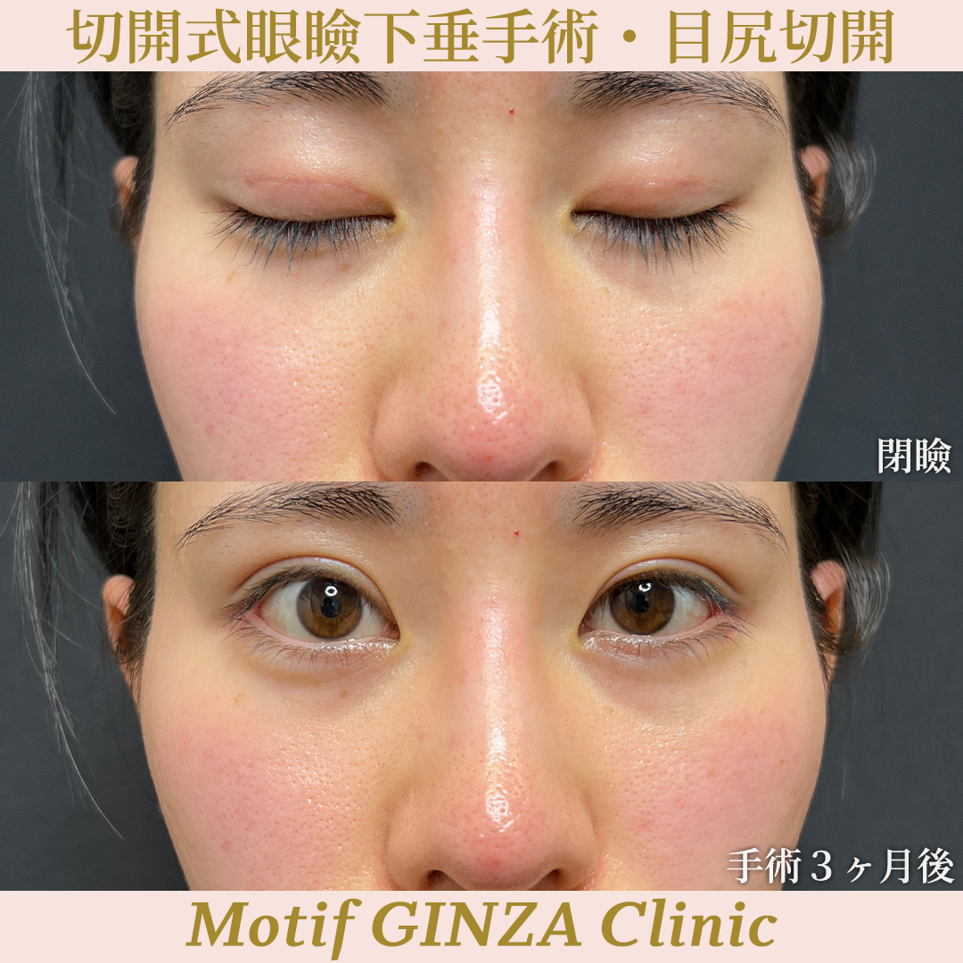 目元複合切開（手術３ヶ月）の写真2