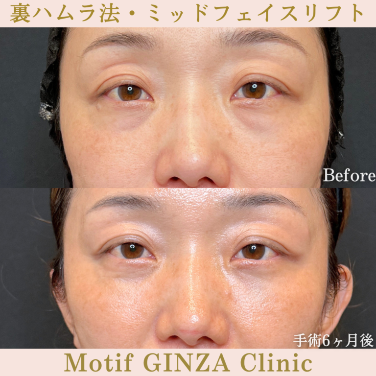 裏ハムラ法・ミッドフェイスリフト（手術6か月）