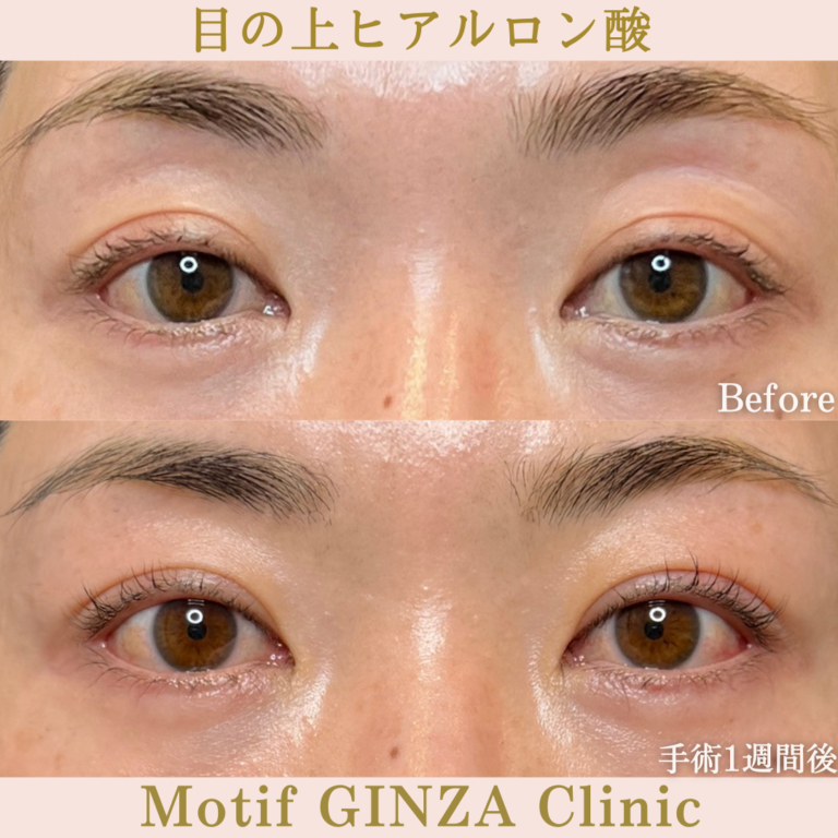 目の上ヒアルロン酸（手術1週間）