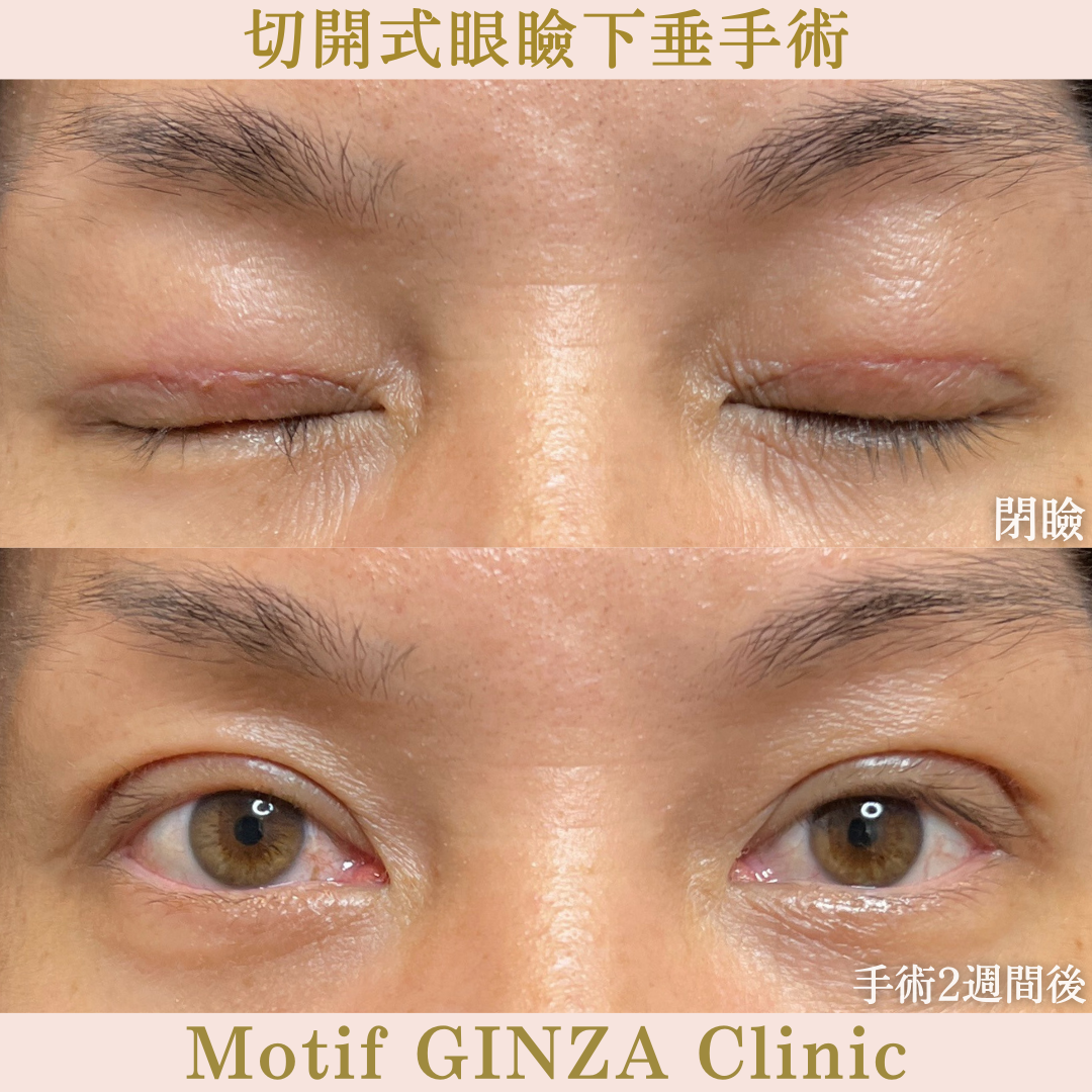 切開式眼瞼下垂手術（手術２週間）の写真2