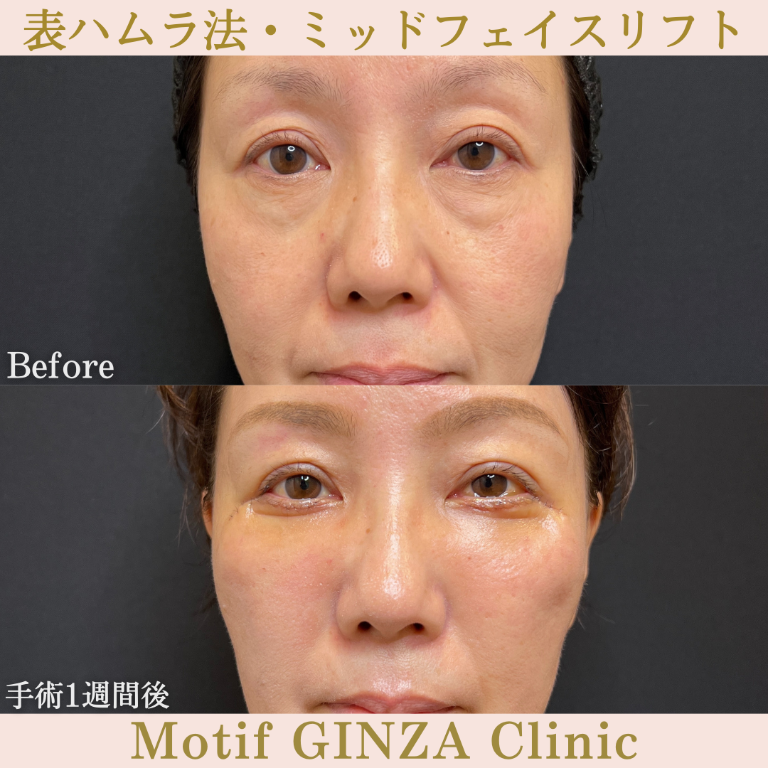 切開式下眼瞼たるみ取り・ミッドフェイスリフト(手術3ヶ月)の写真6