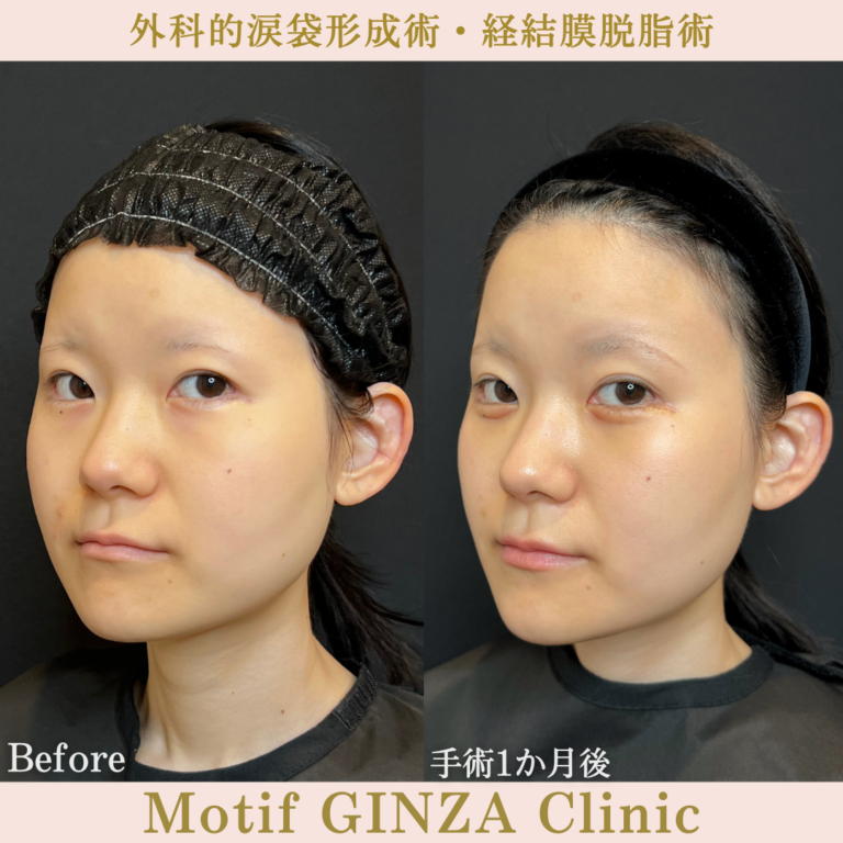 外科的涙袋形成術・経結膜脱脂術（手術３か月）の写真6