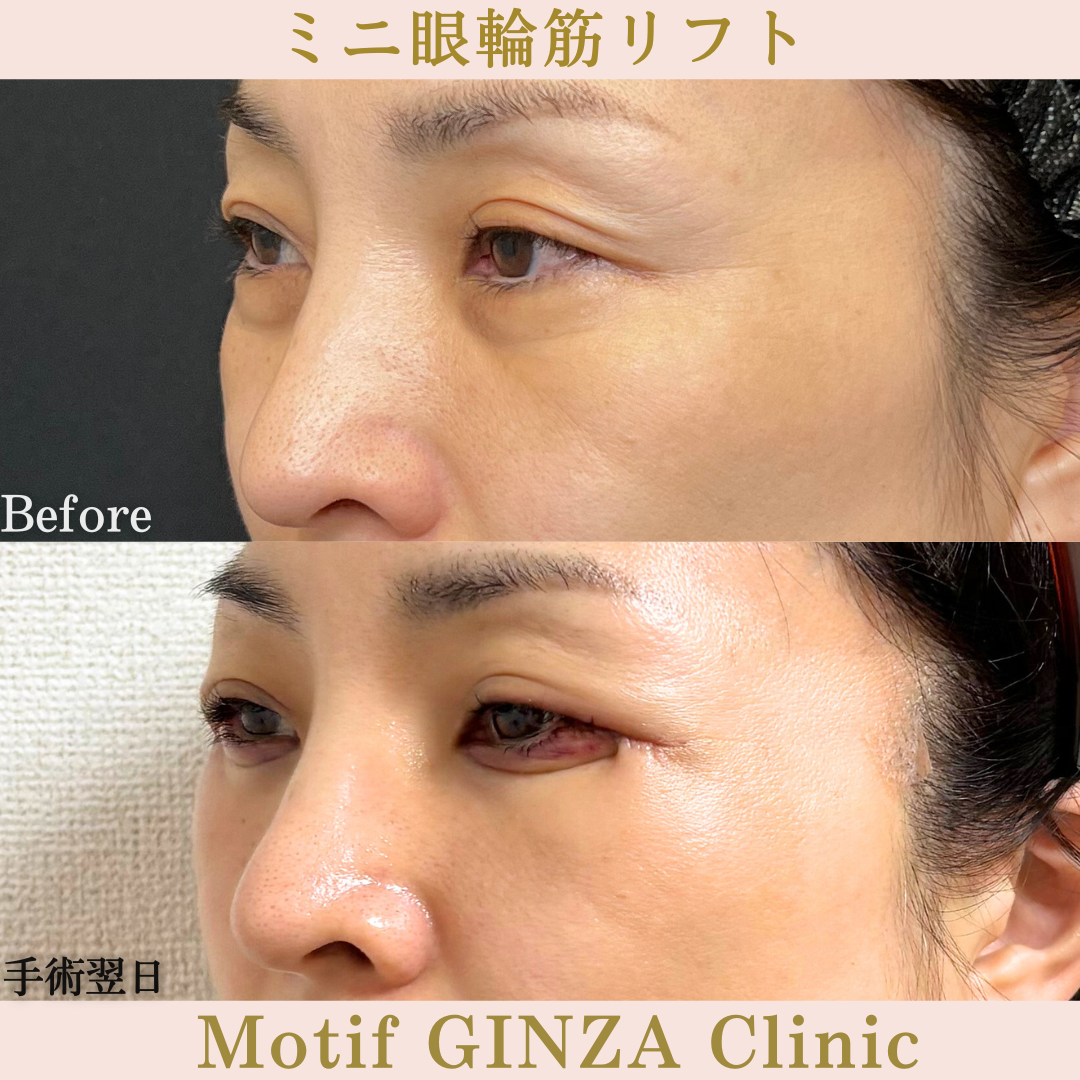 ミニ眼輪筋リフト（手術３か月）の写真6