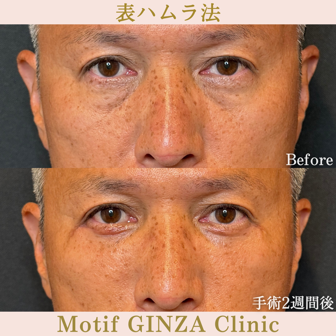 表ハムラ法（手術1か月）の写真3