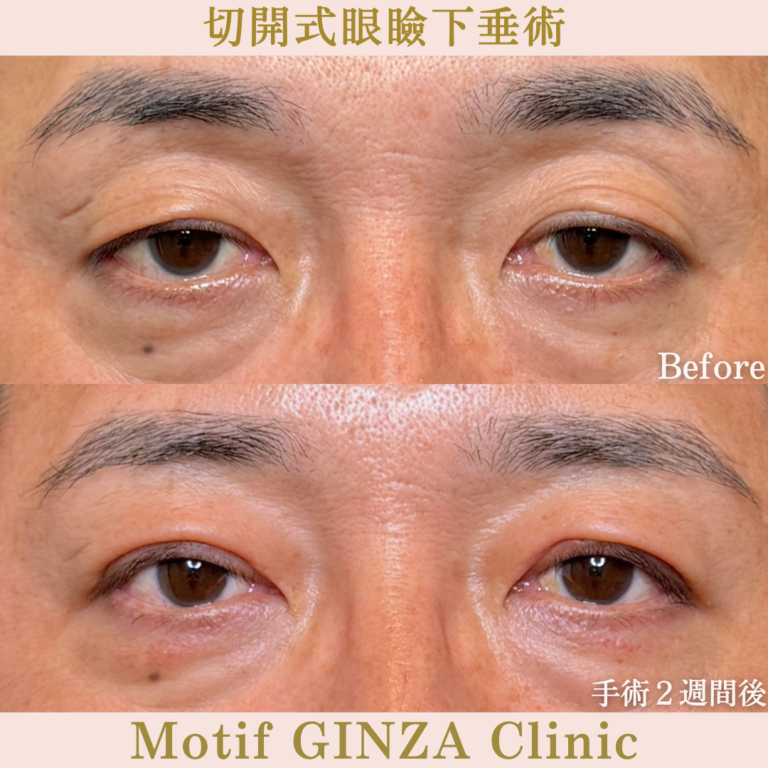 切開式眼瞼下垂手術(手術3か月)の写真4