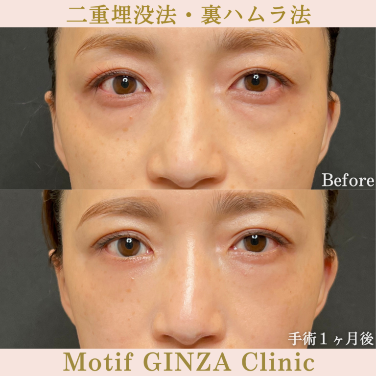 二重埋没法・裏ハムラ法（手術３か月）の写真3