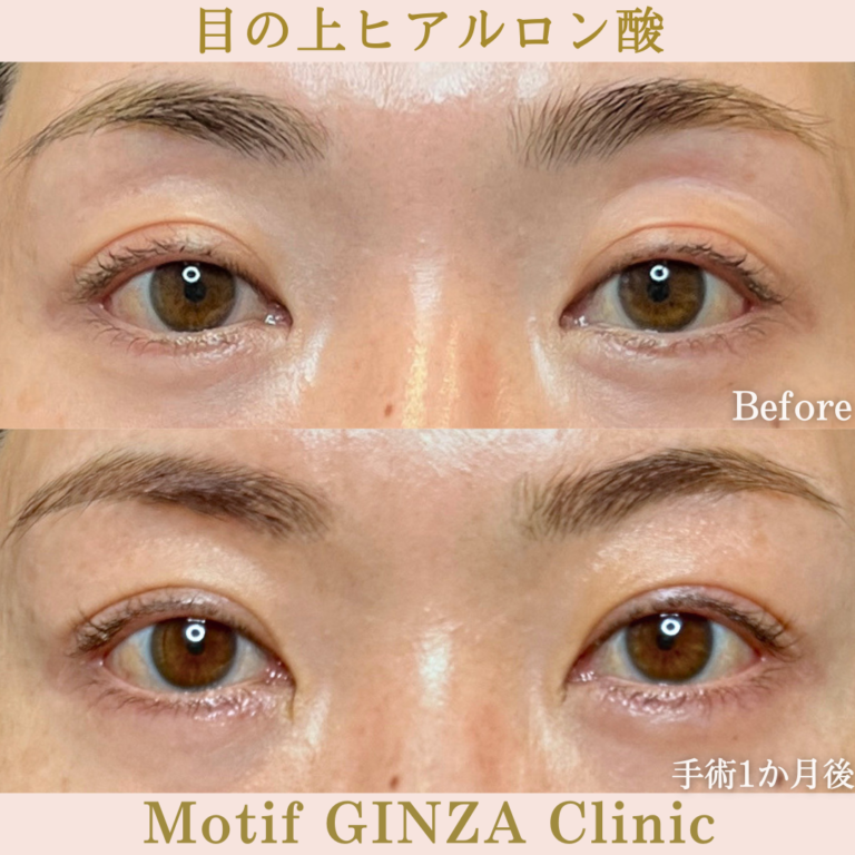 目の上ヒアルロン酸（手術１か月）
