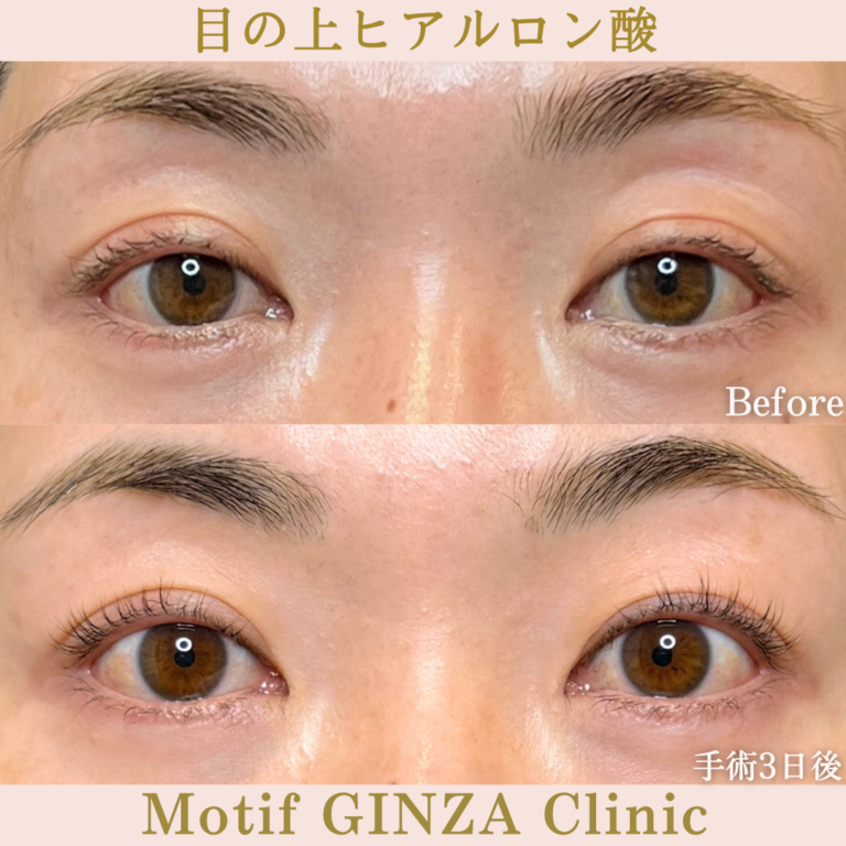 目の上ヒアルロン酸（手術1週間）の写真2
