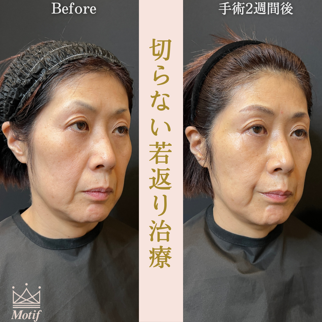 切らない若返り治療（手術１ヶ月）の写真3