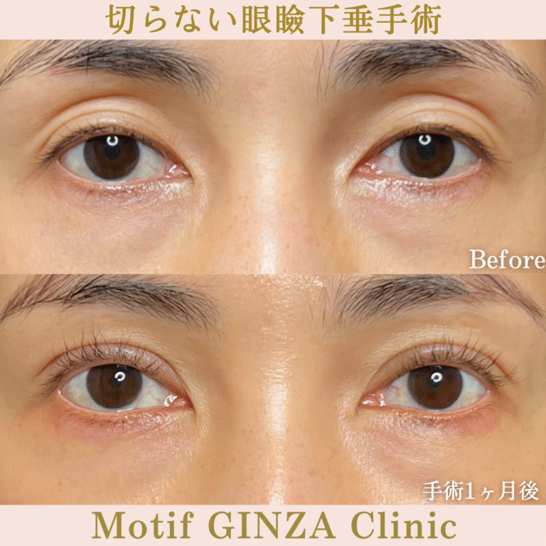 切らない眼瞼下垂手術(手術1か月)