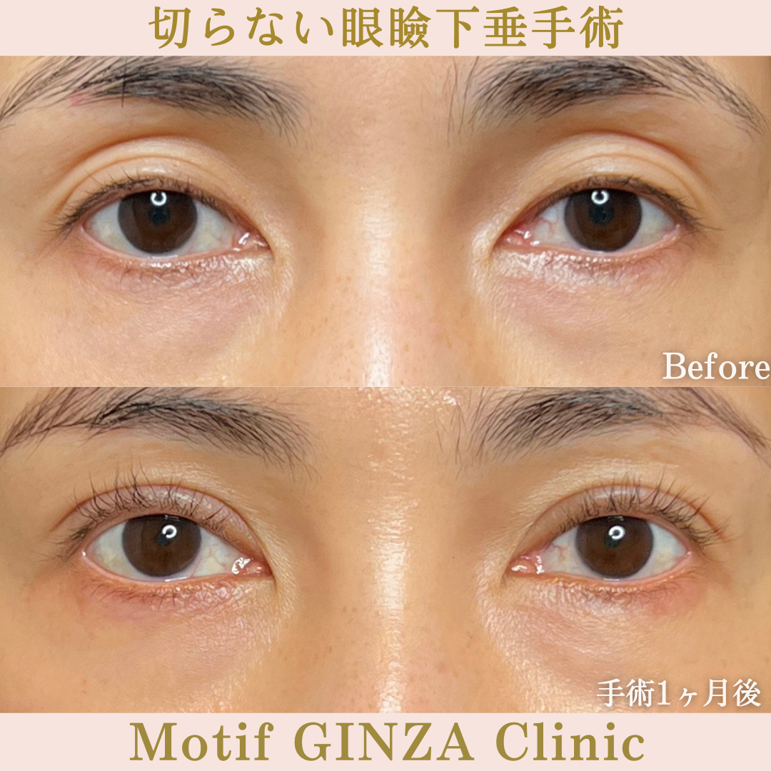 切らない眼瞼下垂手術（手術１か月）の写真