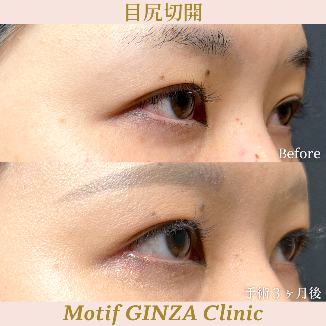 目尻切開手術（手術３ヶ月）の写真2
