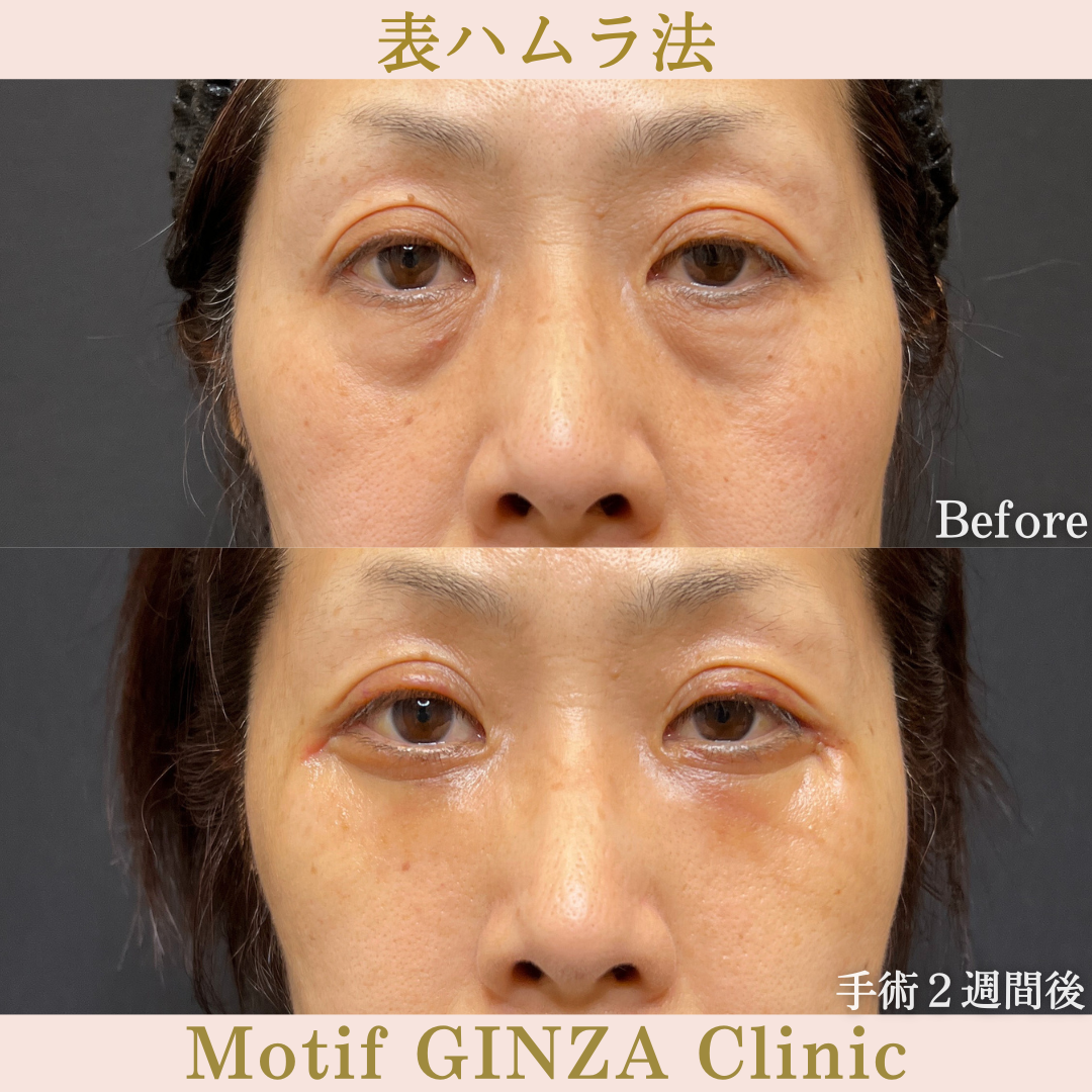 切開式下眼瞼たるみ取り(手術3ヶ月)の写真5