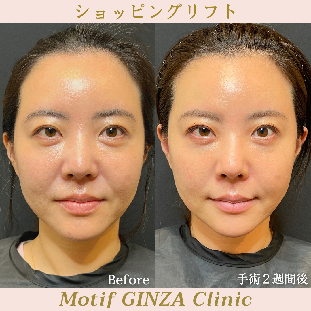 ショッピングリフト（手術２週間）の写真