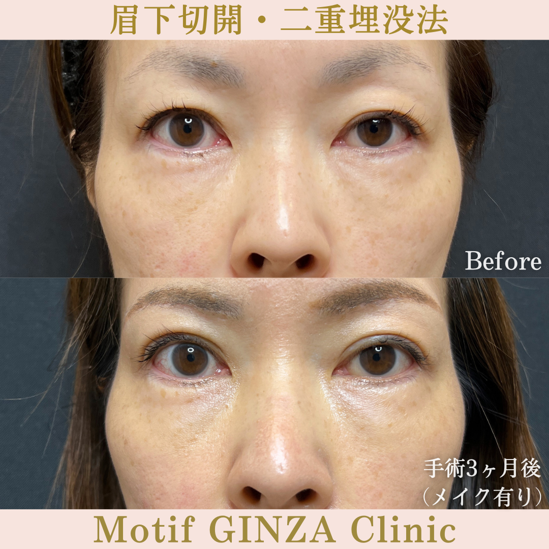 眉下切開・二重埋没法（手術３ヶ月）の写真