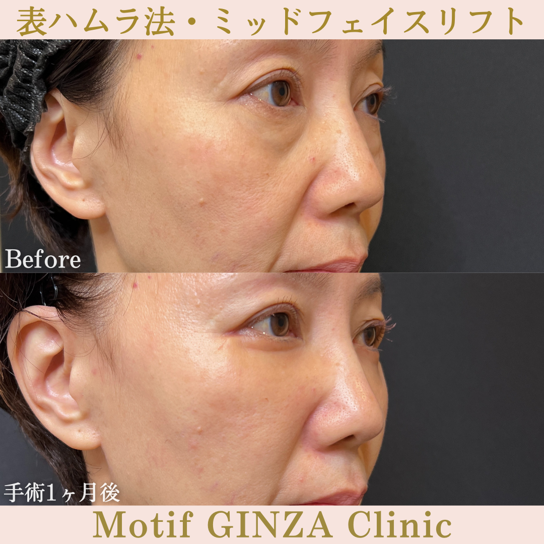 切開式下眼瞼たるみ取り・ミッドフェイスリフト(手術3ヶ月)の写真4
