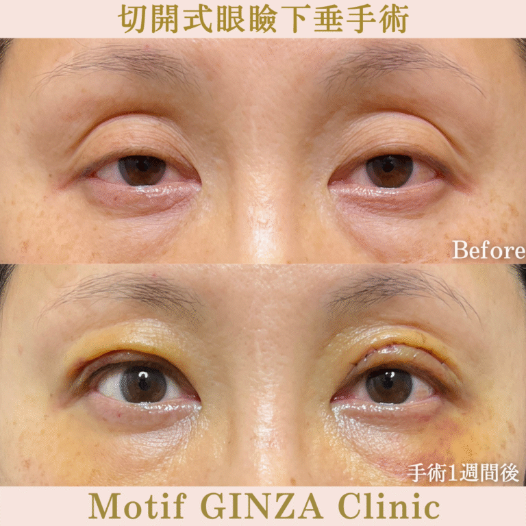 切開式眼瞼下垂手術（手術６ヶ月）の写真6